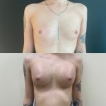 До и после увеличения груди с подтяжкой в Lokman Hekim Istanbul Hospital, улучшенный контур