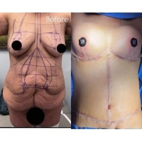 Résultats avant et après réduction mammaire chez Lucio Santos Plastic Surgery, contour amélioré