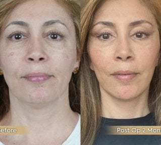Before and after facial fat transfer results at Dr. Safa Manav Clinic, improved facial volume