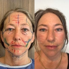 Before and after facial fat transfer results at Dr. Safa Manav Clinic, rejuvenated appearance
