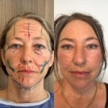 Before and after facial fat transfer results at Dr. Safa Manav Clinic, rejuvenated appearance