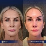 Before and after facial fat transfer results at Dr. Safa Manav Clinic, 7 months post-op