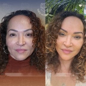 Before and after facial fat transfer results at Dr. Safa Manav Clinic, enhanced facial volume
