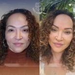 Before and after facial fat transfer results at Dr. Safa Manav Clinic, enhanced facial volume