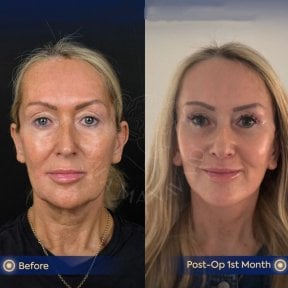 Before and after facial fat transfer results at Dr. Safa Manav Clinic, improved facial volume