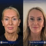 Before and after facial fat transfer results at Dr. Safa Manav Clinic, improved facial volume