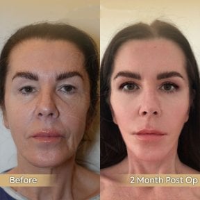 Before and after facial fat transfer results at Dr. Safa Manav Clinic, 2 months post-op