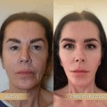 Before and after facial fat transfer results at Dr. Safa Manav Clinic, 2 months post-op