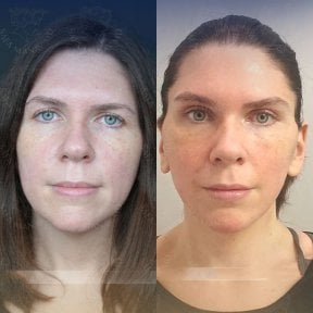 Before and after facial fat transfer results at Dr. Safa Manav Clinic, enhanced facial volume