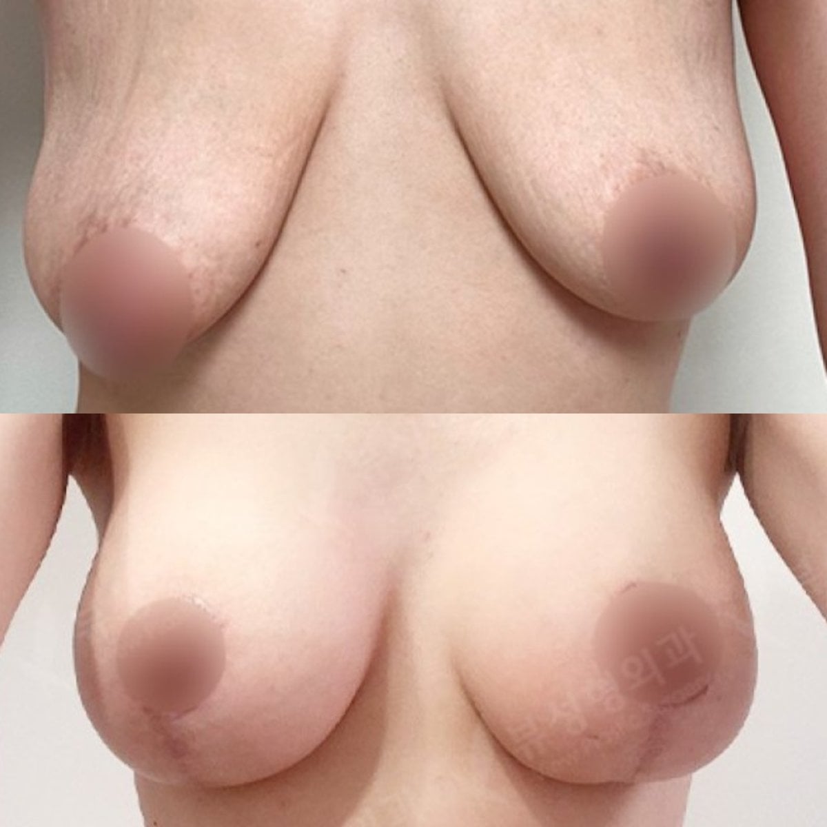 قبل وبعد تكبير ورفع الثدي في View Plastic Surgery Hospital، تحسين شكل الصدر