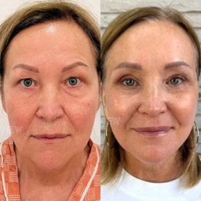 Результати нижньої блефаропластики до і після у View Plastic Surgery Hospital