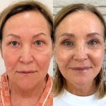 Результати нижньої блефаропластики до і після у View Plastic Surgery Hospital