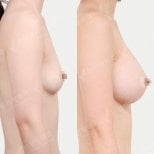نتائج قبل وبعد تكبير الثدي في View Plastic Surgery Hospital، زيادة الحجم