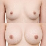 نتائج قبل وبعد تكبير الثدي في View Plastic Surgery Hospital، ثدي ممتلئ