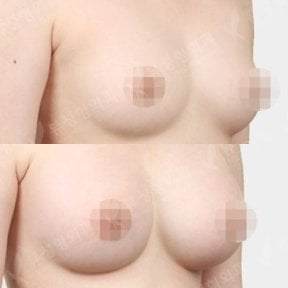 نتائج قبل وبعد تكبير الثدي في View Plastic Surgery Hospital، ثديان أكثر امتلاءً