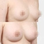 نتائج قبل وبعد تكبير الثدي في View Plastic Surgery Hospital، ثديان أكثر امتلاءً