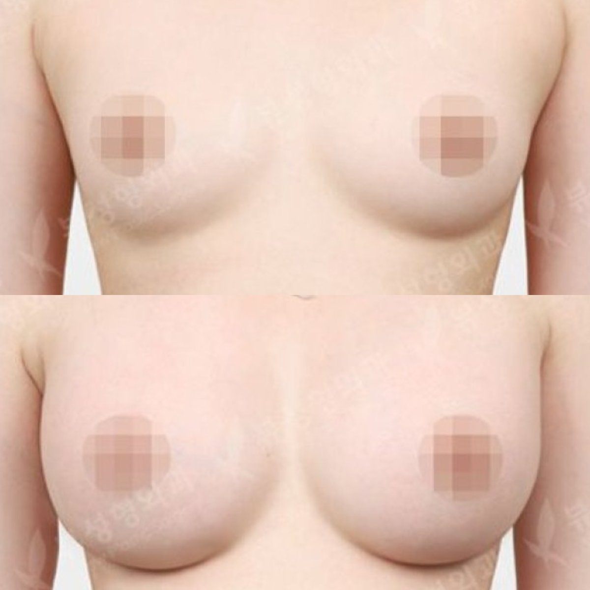 نتائج قبل وبعد تكبير الثدي في مستشفى View Plastic Surgery، ثدي ممتلئ أكثر