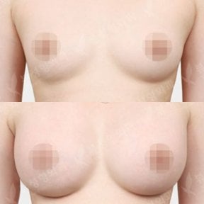 نتائج قبل وبعد تكبير الثدي في مستشفى View Plastic Surgery، ثدي ممتلئ أكثر