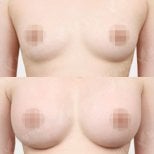 نتائج قبل وبعد تكبير الثدي في مستشفى View Plastic Surgery، ثدي ممتلئ أكثر