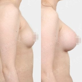 نتائج قبل وبعد تكبير الثدي في View Plastic Surgery Hospital، صدر أكثر امتلاءً