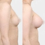 نتائج قبل وبعد تكبير الثدي في View Plastic Surgery Hospital، صدر أكثر امتلاءً