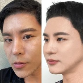 Resultados antes y después de cirugía ortognática en View Plastic Surgery Hospital, contorno facial