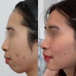Resultados antes y después de cirugía ortognática en View Plastic Surgery Hospital, alineación mandibular