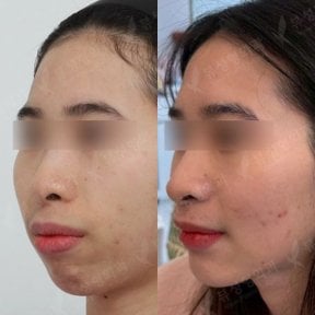 Resultados antes y después de cirugía ortognática en View Plastic Surgery Hospital, perfil facial mejorado