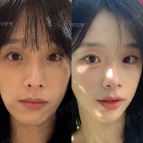 Resultados antes y después de cirugía ortognática en View Plastic Surgery Hospital, contorno facial