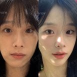 Resultados antes y después de cirugía ortognática en View Plastic Surgery Hospital, contorno facial