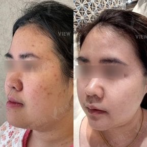 Antes y después de cirugía ortognática en View Plastic Surgery Hospital, resultados faciales