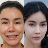 Resultados antes y después de cirugía ortognática en View Plastic Surgery Hospital, cambio facial