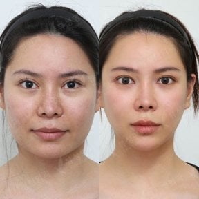 Resultados antes y después de implante de mentón en View Plastic Surgery Hospital, contorno mejorado