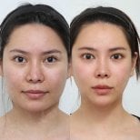 Resultados antes y después de implante de mentón en View Plastic Surgery Hospital, contorno mejorado