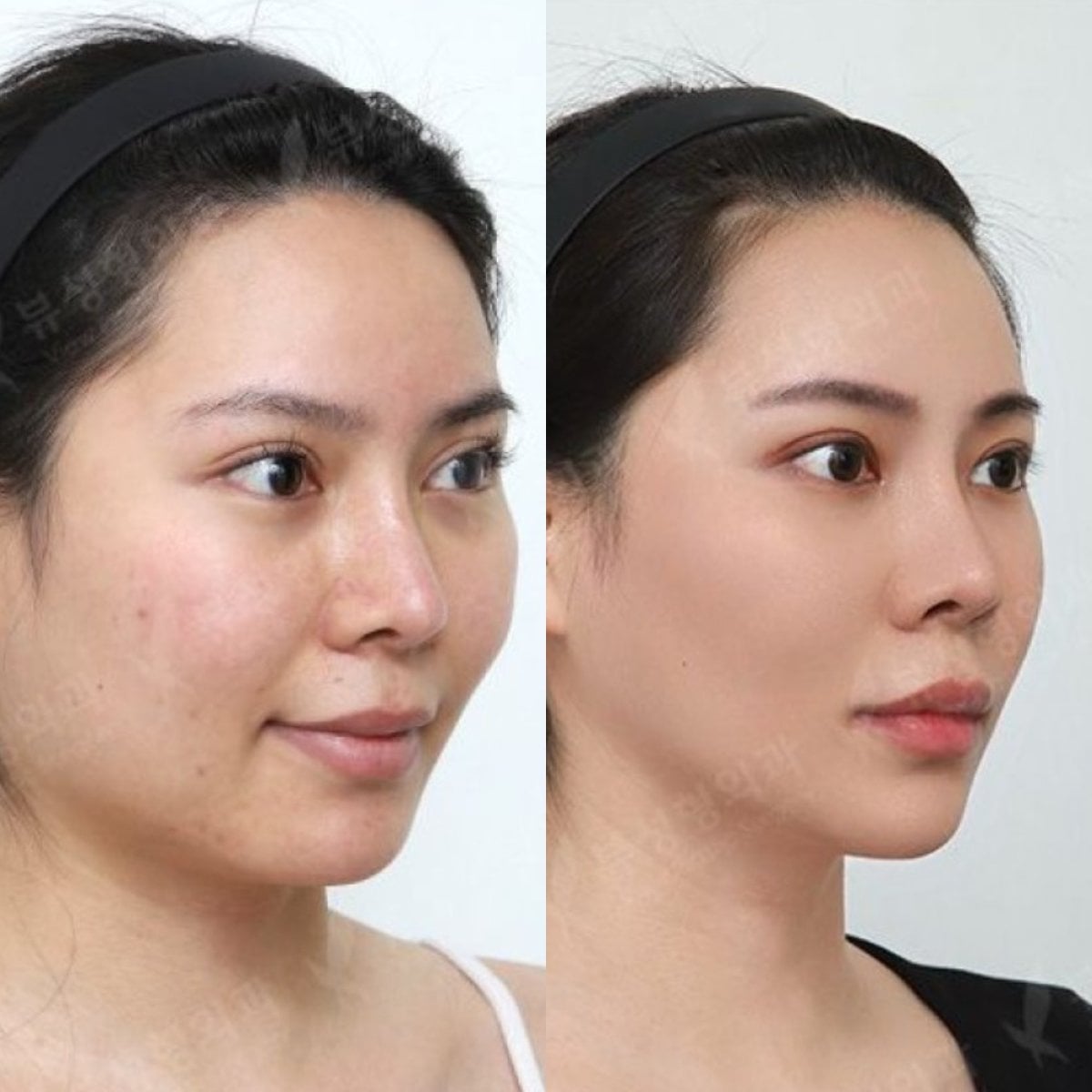 نتائج قبل وبعد زراعة الذقن في مستشفى View Plastic Surgery، تحديد الذقن المحسن