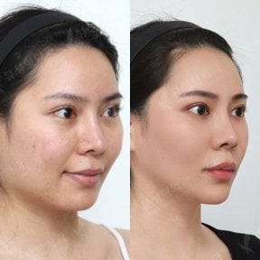 Resultados antes y después de implante de mentón en View Plastic Surgery Hospital, contorno mejorado