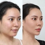 Resultados antes y después de implante de mentón en View Plastic Surgery Hospital, contorno mejorado