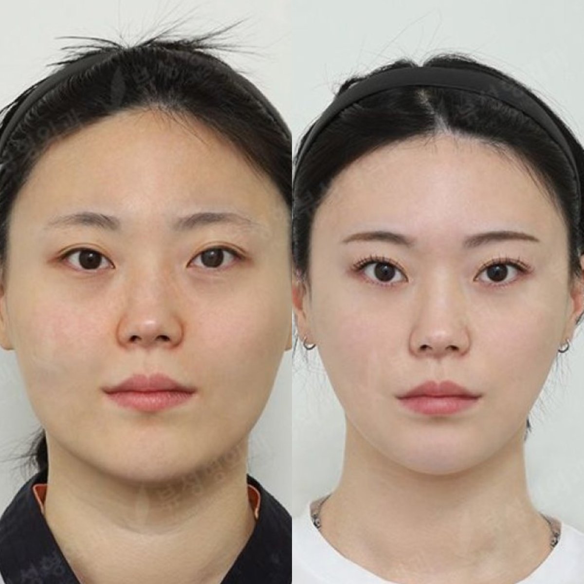 نتائج قبل وبعد زراعة الذقن في مستشفى View Plastic Surgery، تحديد الذقن المحسن