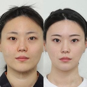 Resultados antes y después de implante de mentón en View Plastic Surgery Hospital, contorno mejorado