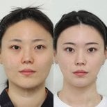 Resultados antes y después de implante de mentón en View Plastic Surgery Hospital, contorno mejorado