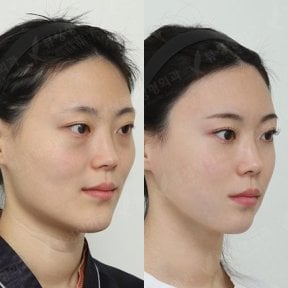 Resultados antes y después de implante de mentón en View Plastic Surgery Hospital, contorno mejorado