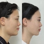 Resultados antes y después de implante de mentón en View Plastic Surgery Hospital, perfil mejorado