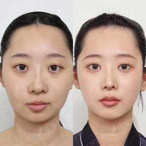 Resultados antes y después de implante de mentón en View Plastic Surgery Hospital, contorno mejorado
