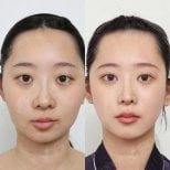 Resultados antes y después de implante de mentón en View Plastic Surgery Hospital, contorno mejorado