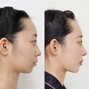 Resultados antes y después de implante de mentón en View Plastic Surgery Hospital, perfil mejorado