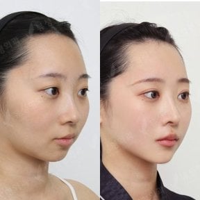 Resultados antes y después de implante de mentón en View Plastic Surgery Hospital, contorno mejorado