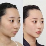 Resultados antes y después de implante de mentón en View Plastic Surgery Hospital, contorno mejorado