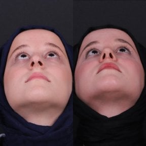 Before and after rhinoplasty results, improved nasal shape and symmetry in female patient