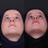 Before and after rhinoplasty results, improved nasal shape and symmetry in female patient