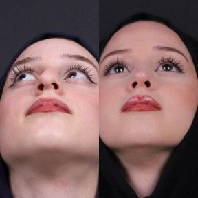 Before and after rhinoplasty results, nose reshaping with improved nasal symmetry